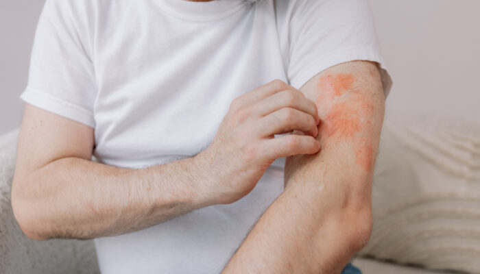 3 ways for managing eczema symptoms