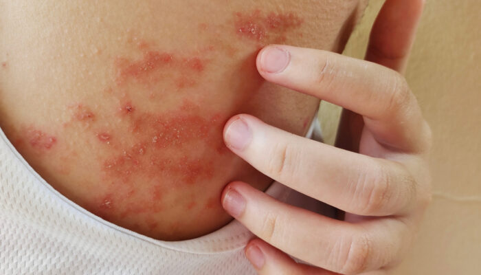3 effective ways to manage atopic dermatitis