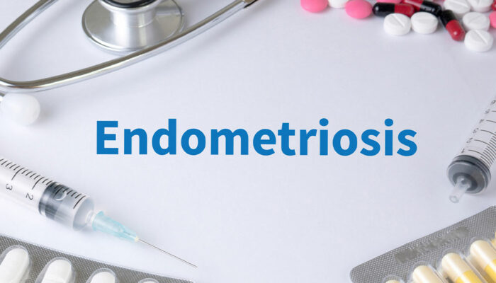 Endometriosis &#8211; Symptoms and natural remedies