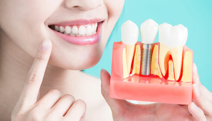 Everything to know about dental implant procedure