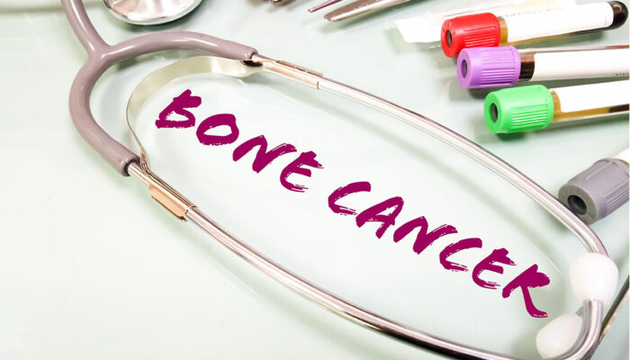 7 warning signs of bone cancer to be aware of