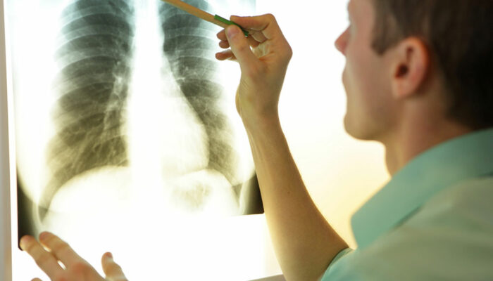 MAC lung disease &#8211; 8 common signs and management options