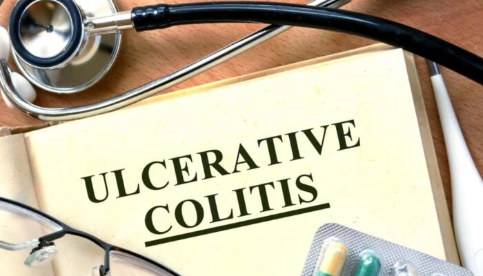 10 early signs of ulcerative colitis to not ignore